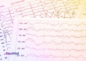 تاثیر نوروفیدبک روی EEG مراجعین