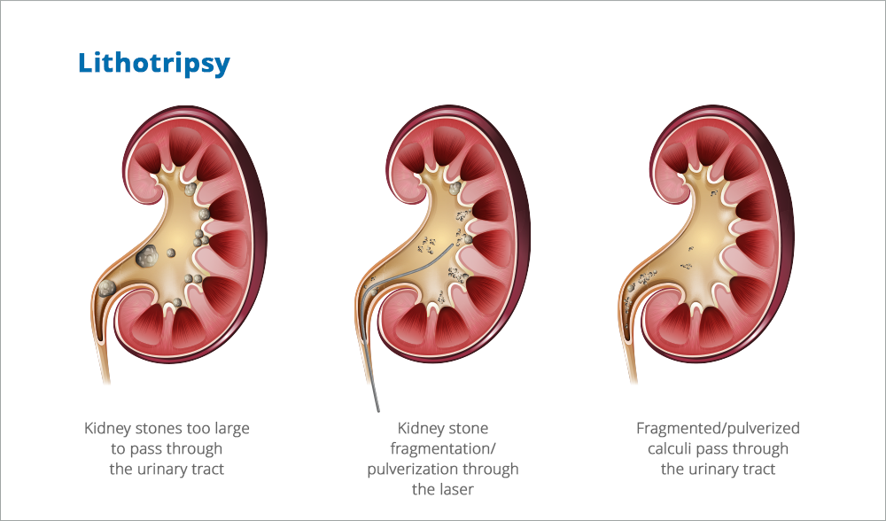 Kidney-stones-lithotripsy-with-laser