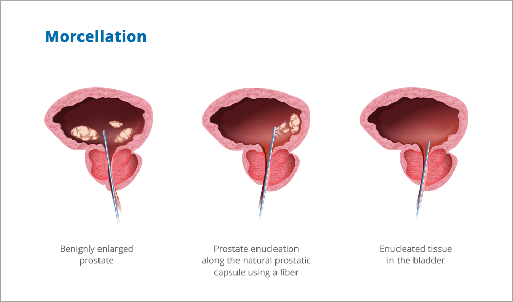 Morcellation-for-enlarged-prostate-enucleation-1