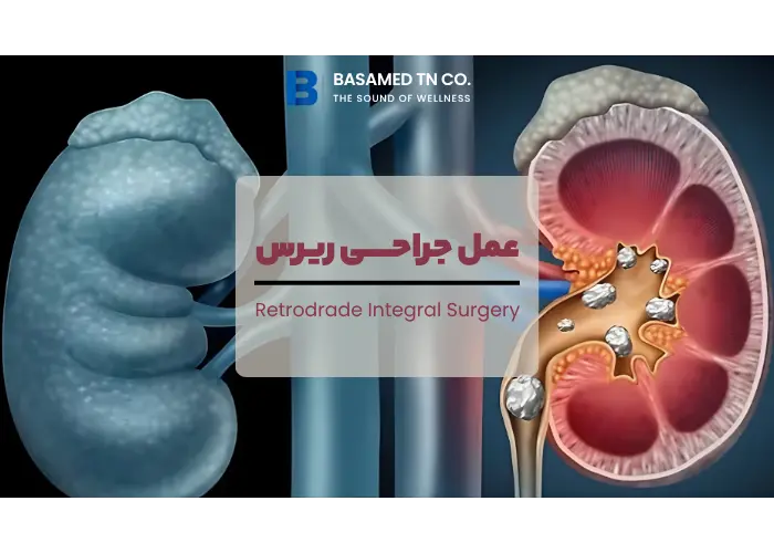 جراحی RIRS