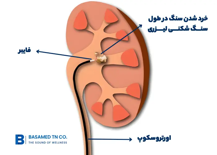 عمل ریرس سنگ کلیه